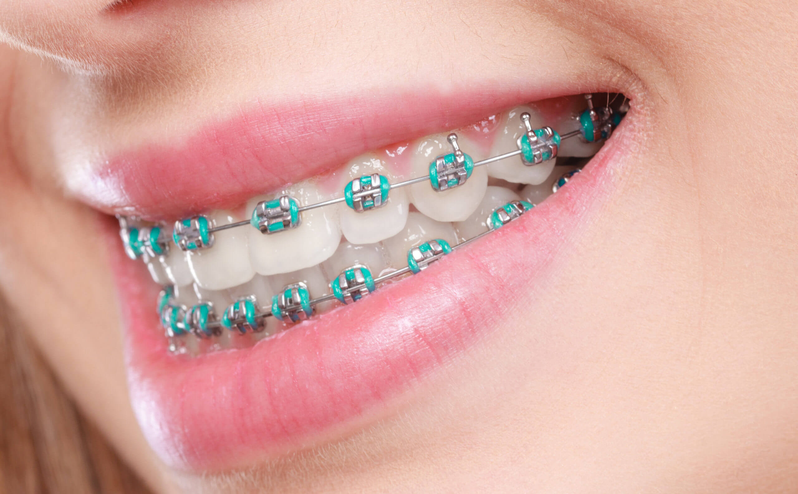 Best Braces & Smiles in Uttarahalli