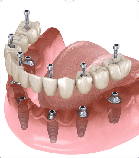 Dental Implant Fixing Doctors in Uttarahalli