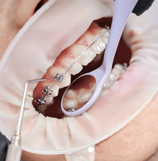 Dental Braces Doctors in Uttarahalli