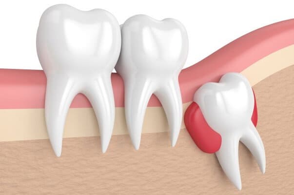 Doctors for Tooth Extraction in Uttarahalli