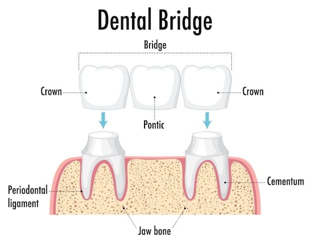 Dental Crown in Uttarahalli