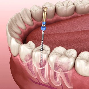 Root Canal Treatment Doctors in Uttarahalli