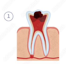 Root Canal Treatment Clinics in Uttarahalli