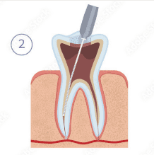 Root Canal Treatment Doctors in Uttarahalli