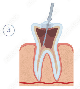 Root Canal Treatment in Uttarahalli