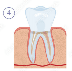 Root Canal Treatment Clinics in Uttarahalli